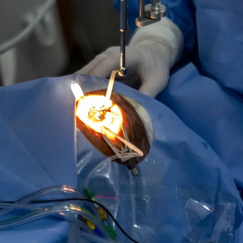 Cirurgia Ocular na Clinica de Olhos Pegado